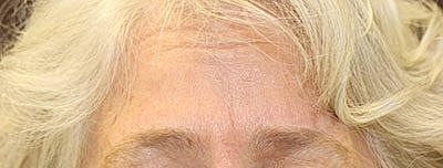 Botox Before & After