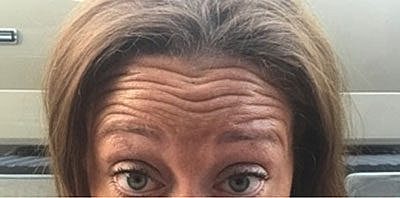 Botox Before & After