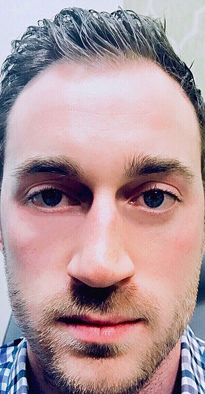 Tear Trough Filler Before & After