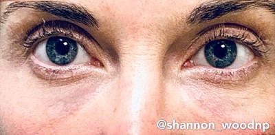 Tear Trough Filler Before & After