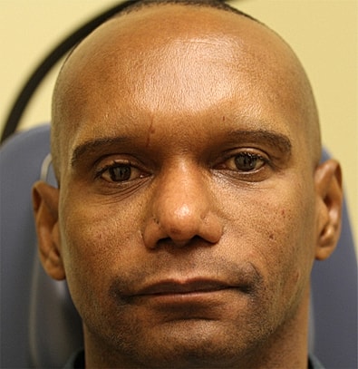 Tear Trough Filler Before & After